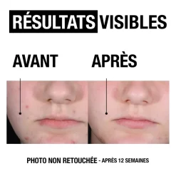 Anti-boutons+ exfoliant liquide Neutrogena - flacon de 125ml